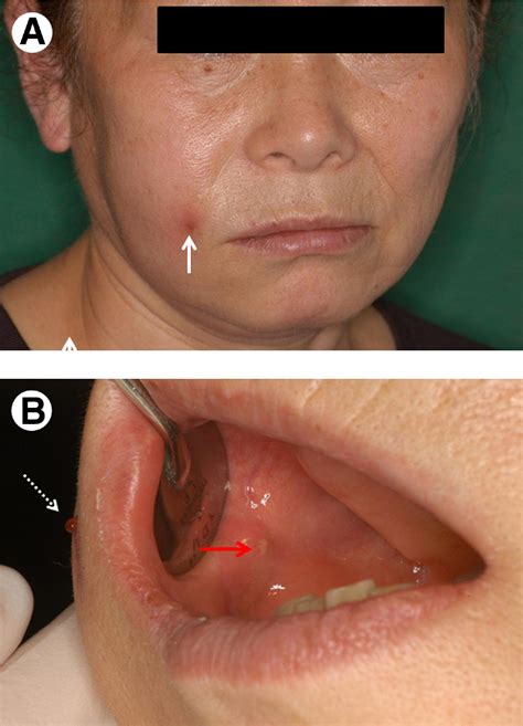 Parotid Gland Duct