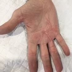 scar management  importance  scars gc hand therapy