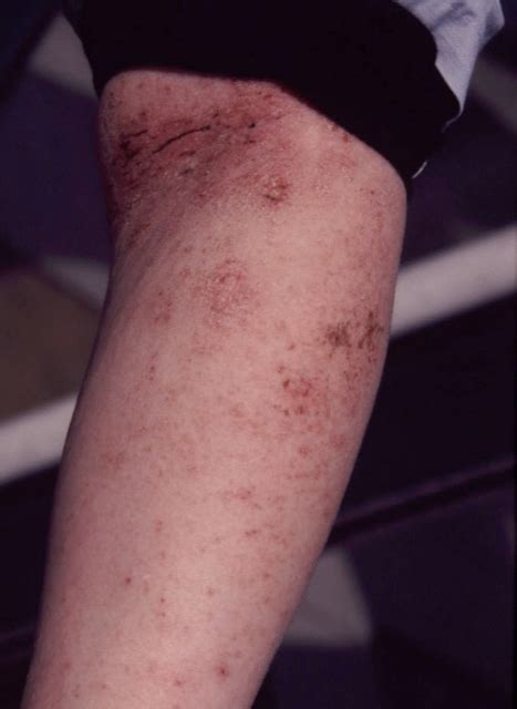 Is Scabies In Dogs Contagious To Humans