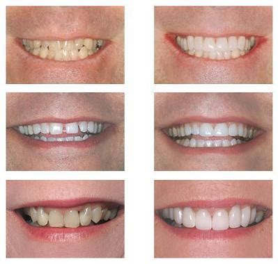 Lente Para Os Dentes Antes E Depois - Lente de contato dental! Quanto custa e onde comprar?