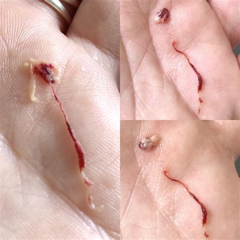2 weeks miscarriage images 8