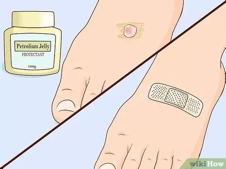 3 Ways to Heal Blisters Fast - wikiHow | How to heal blisters, Blister ...