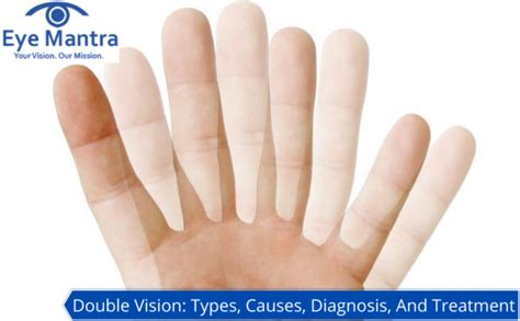 Double Vision (Diplopia): Causes, Treatment, And Eye Exercises