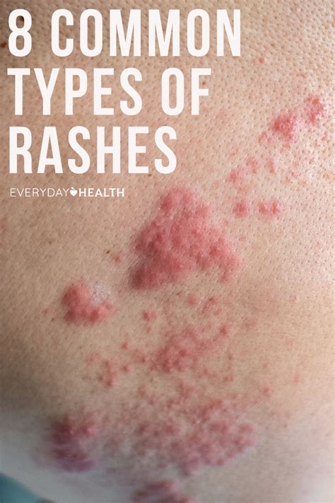 Skin Rashes In Children