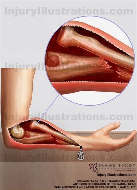 Ulnar Head Fracture