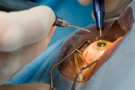 Types Of Cataract Surgery: Examples, Benefits, Drawbacks, Tips