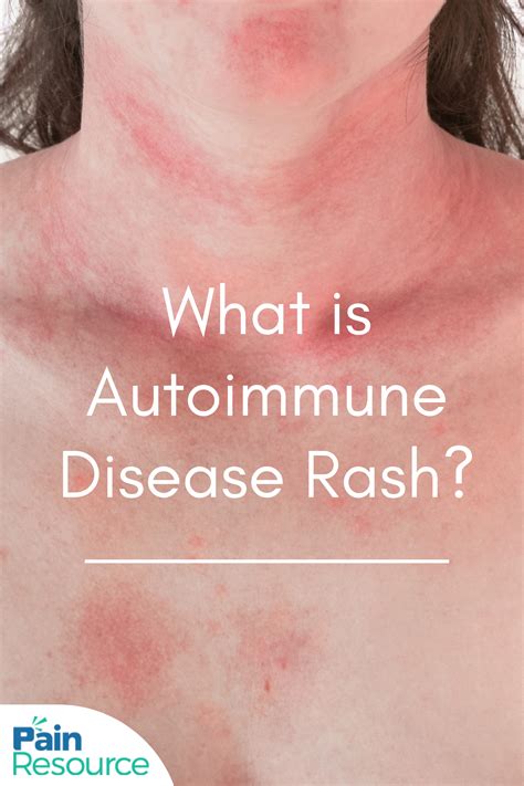 What is autoimmune rash – Artofit