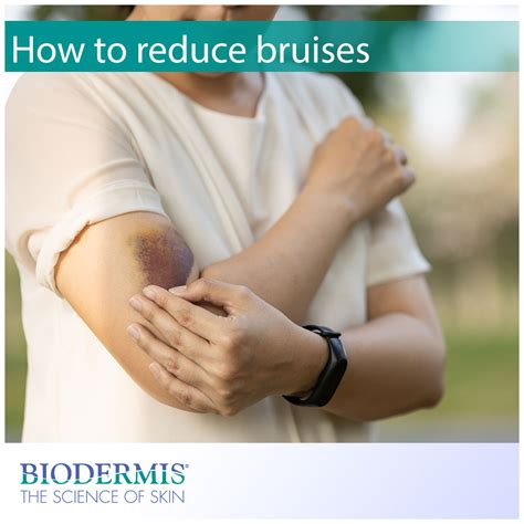 reduce bruising   medical procedure biodermiscom