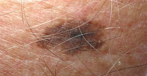 study  case  improved melanoma diagnostic tools clinical