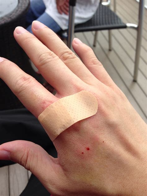 Is It Necessary To Take Injection After Puppy Bite