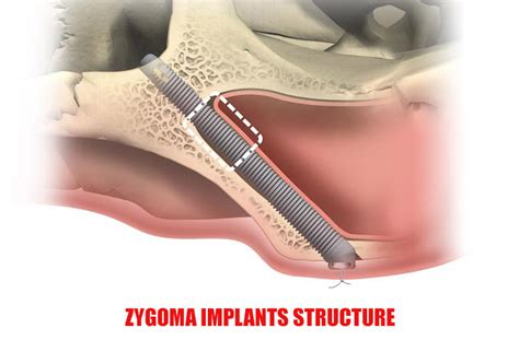 Zygoma Implants for Upper Jaw: Advantages, Benefits, Procedure, Cost ...