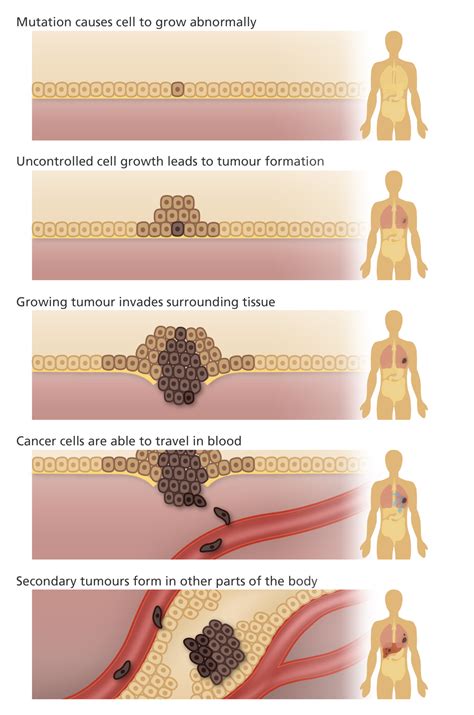 Is cancer a genetic disease?