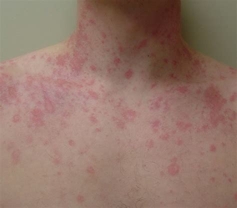Pityriasis Rosea