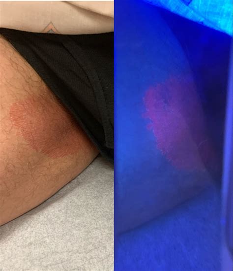 rash   older mans groin consultant