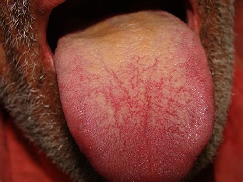 White Coating on Tongue – Pictures, Causes, Treatment