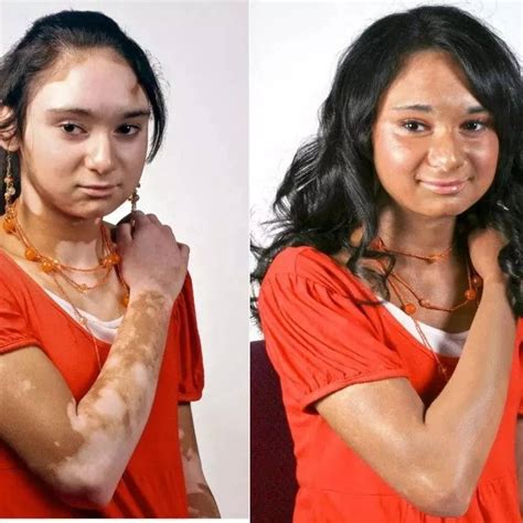 A cure for vitiligo? New US$2,000 treatment is restoring skin