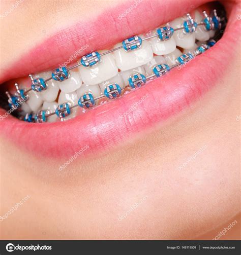 dark blue braces color 2