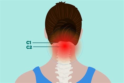 rheumatoid arthritis  cervical spine treatment