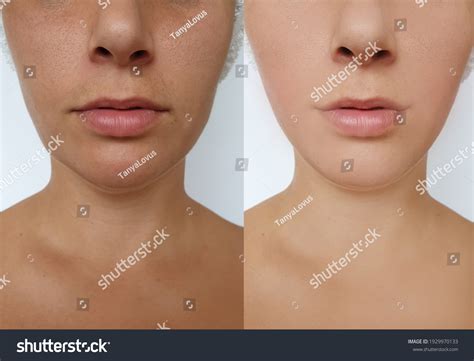 Woman Face Lift Before After Treatment Stock Photo 1929970133 ...