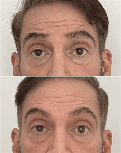 Before & After - Anti-Wrinkle Injections - Dr Richard Sibthorpe