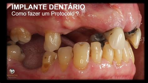 Pus No Implante Dentario O Que Fazer - Implante Dentário - Como fazer uma Prótese Protocolo ? - YouTube