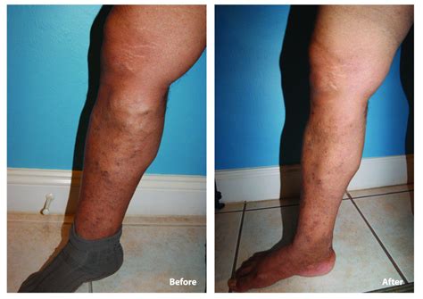 Effective Treatment for Venous Insufficiency • Southwest Florida's ...