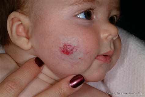 Hemangioma in Children: Symptoms, Incidence, & Treatment | Health Digest