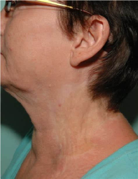 final results   wound  respect  scar formation show