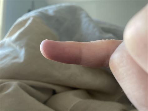 Circule appeared on my pinky. Could it be a wart or something else