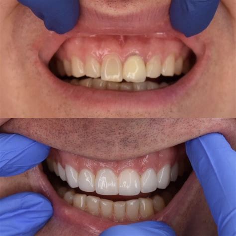 Before and After Veneers Procedure | Dr. Christian Chung, D.D.S.