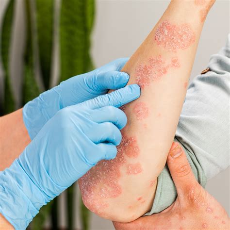 Vitamin D Deficiency Skin Rash Pictures at Milla Levi blog