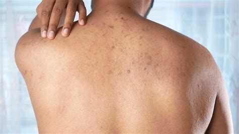 como saber  las manchas en la piel son malignas  peligrosas