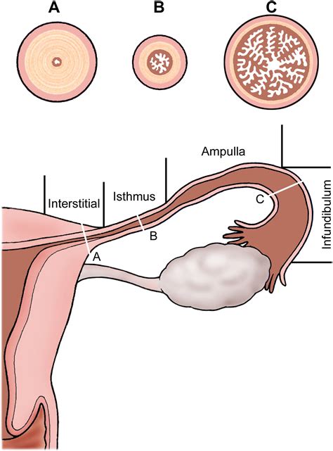 Discriminative MRI features of fallopian tube masses - Clinical Radiology