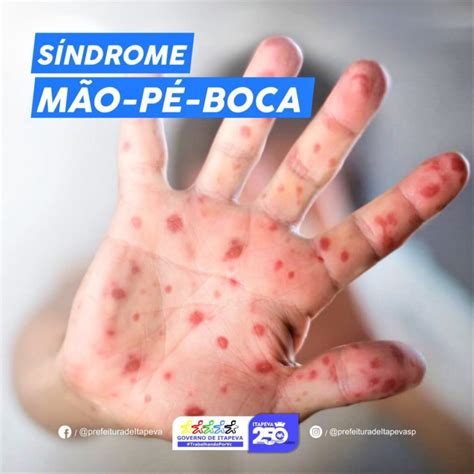 Mao Pe Boca Pega Duas Vezes - Doença Mão-Pé-Boca (HFMD) – Então Saúde
