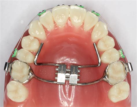 Orthodontic Appliances | Dr Pascal Carrière