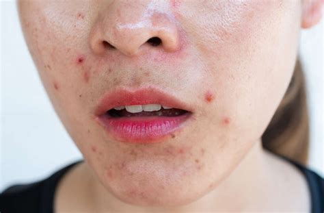 finding  acne specialist  marietta georgia acworth dermatology