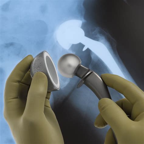 Hip Replacement Sugery Hip Replacement Surgery Facts