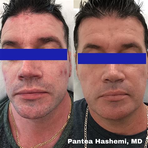 Skin Growths - University Skin Institute