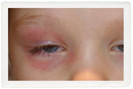 Cellulitis Under Eye