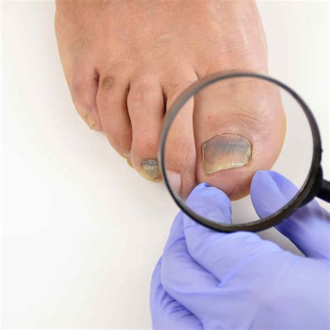 เล็บเท้าห้อเลือด รักษาอย่างไร ต้องถอดเล็บไหม ทำยังไงถึงจะหายปวด