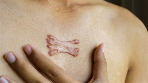scars permanent  science