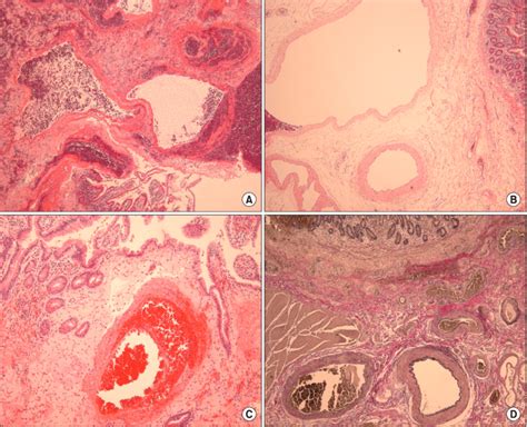 ectatic vascular structures  noted   mucosa