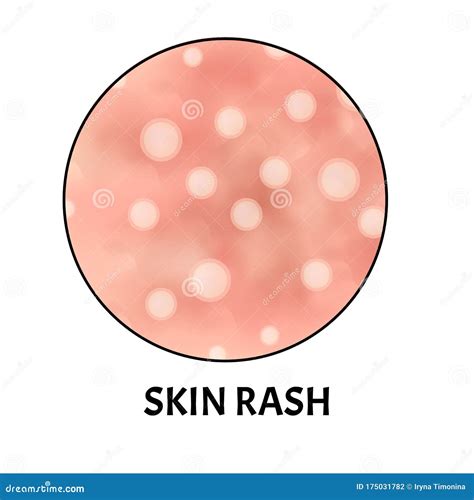 Skin Rash. Symptom Of Dermatitis, Allergies, Psoriasis, Eczema. Icons