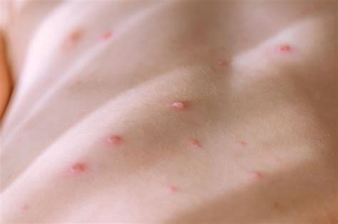 Bolinhas No Corpo Da Criança O Que Pode Ser - Pequenas bolhas que coçam cobrindo a pele do corpo de uma criança com ...
