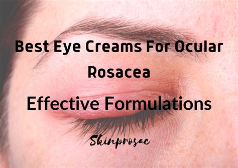 11 Best Eye Cream For Ocular Rosacea 2022 - Skinprosac