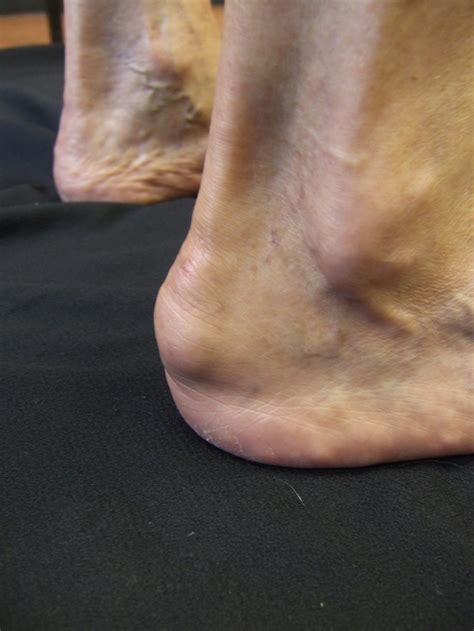 Heel Bump: Haglund — Stanmore foot & ankle surgery