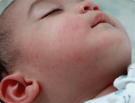 Dengue Incha O Rosto - Dúvidas: Perguntas Frequentes | Conheça a Dengue