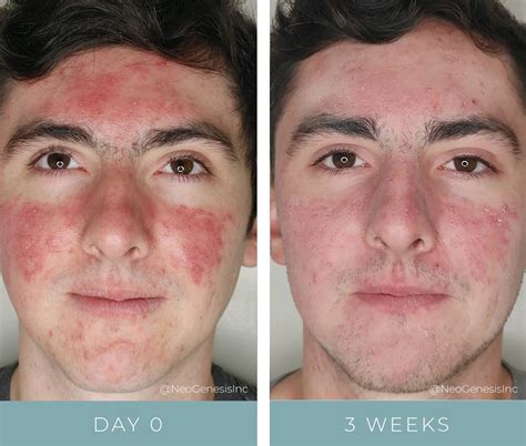 Salicylic Acid Before And After