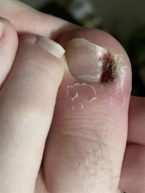 Is this normal one year after phenol matrixectomy? : r/Ingrown_Toenails