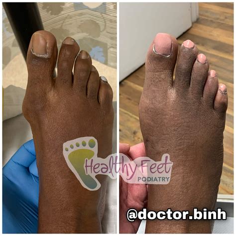 Minimally Invasive Bunion Surgery Wesley Chapel FL